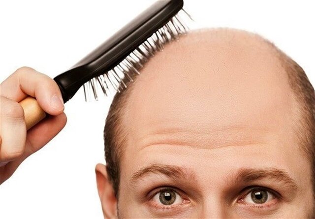 ریزش مو ژنتیکی + ریزش مو + کاشت مو + موسسه پوست و مو هلیا