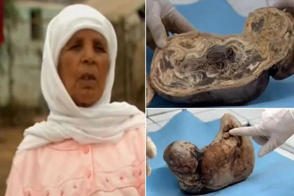 به دنیا آمدن یک نوزاد سنگی از یک زن پس از ۴۵ سال! +تصاویر